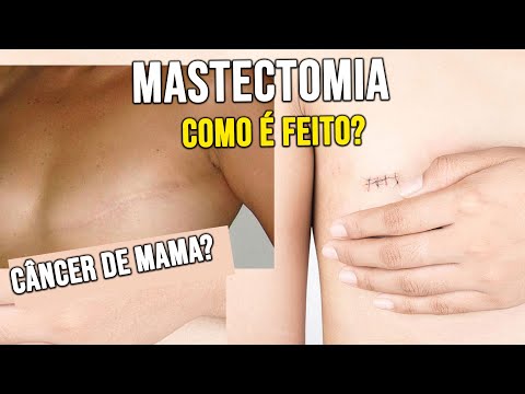 Vídeo: Como se preparar para uma mastectomia (com fotos)