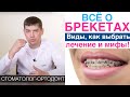 Брекеты - виды, лечение кривых зубов брекетами, преимущества и мифы о брекетах!