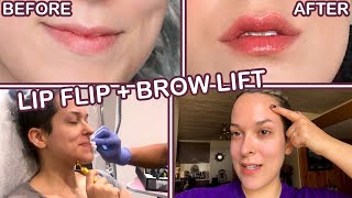 I GOT BOTOX!: LIP FLIP, BROW LIFT, 11s [NO NEEDLES SHOWN]