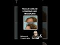 Dallas Female Hairline Lowering Hair Transplant Before and After