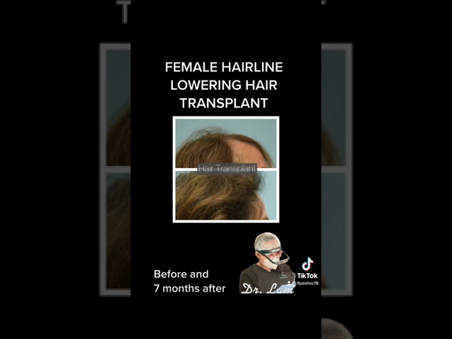 Dallas Female Hairline Lowering Hair Transplant Before and After