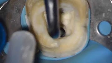 How to remove a fiber post