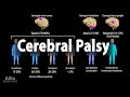 Cerebral palsy animation