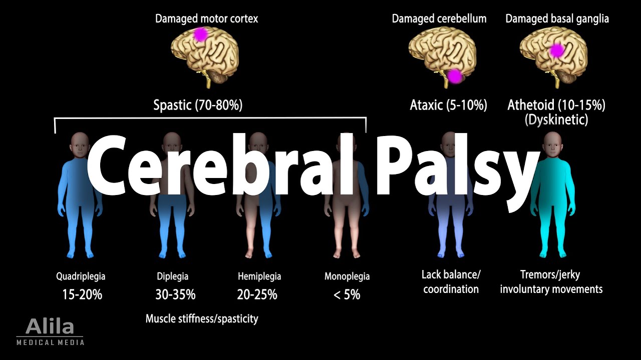 Cerebral Palsy Brain