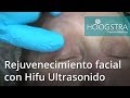 Rejuvenecimiento facial con Hifu Ultrasonido (20015)