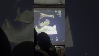 10 wk pregnancy 🤰