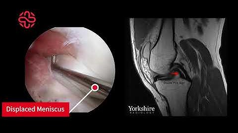 Meniscal Bucket Handle Tear