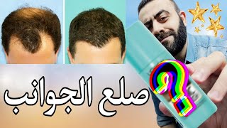 ملئ فراغات الشعر في مقدمة الراس بسرعه | حل يستخدمه مشاهير الفن حول العالم - Toppik Hair Fibers