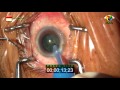 Cataract surgery  opration de la cataracte 1354