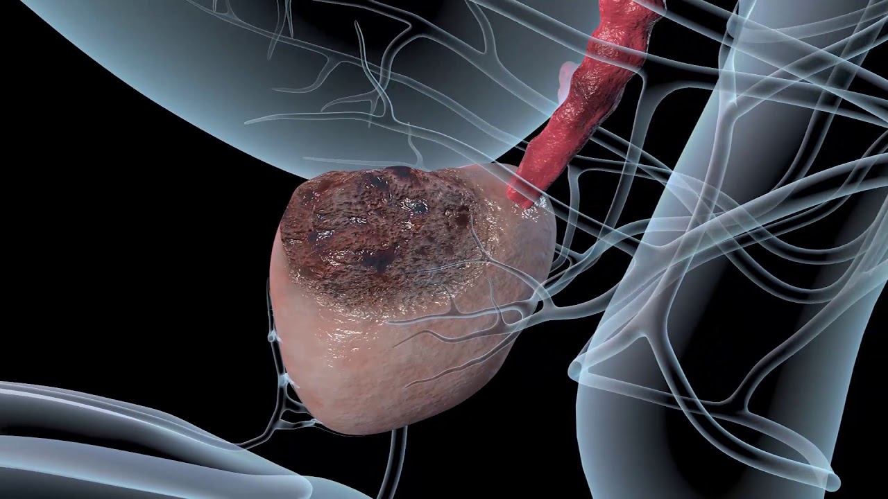 Prostate Cancer what you must know YouTube