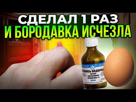 Старый дерматолог: растворяю бородавки и папилломы перекисью и яйцом