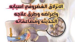 الانزلاق الغضروفي اعراضه واسبابه وكيفية والوقاية منه ومضاعفاته وطرق علاجه الحديثه