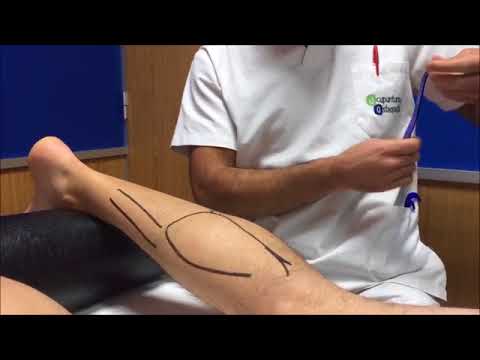 acupunturista en chihuahua Tratamiento de Fascitis Plantar con Ganchos