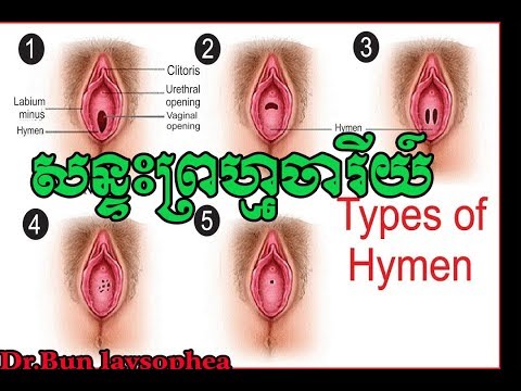 ​ប្រភេទ សន្ទះ ព្រហ្មចារី​យ៍​ Type of Hymen by Dr.bun laysophea