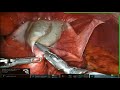 Robotic unroofing of a large left hepatic biliary cyst