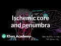 Understanding Ischemic Stroke