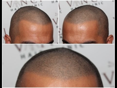 What is micro hair pigmentation or scalp micropigmentation? - 2pass Clinic