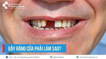 Gãy răng cửa phải làm sao?
