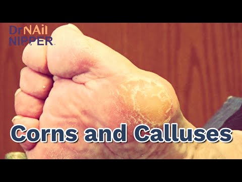 What are foot pressure points? Corns and Calluses, Dr Nail Nipper [Callus Tuesday] (2020)