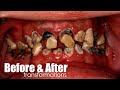 Before & After Smile Makeover Transformations By Luke Kahng