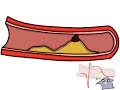 Ateromatosis e infartos-- Dr. Huge Stat