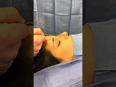 Video thumbnail: A question that is frequently asked is can I put nose ring in after a rhinoplasty?  Yes · Happiness Plastic Surgery - Dr. Weinfeld