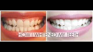 How I've Been Whitening My Teeth at Home | Summer Saldana