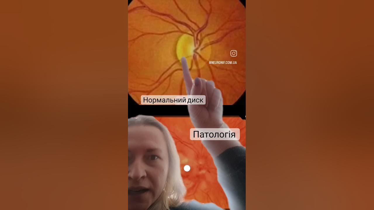 офтальмоскопія, огляд очного дна - YouTube