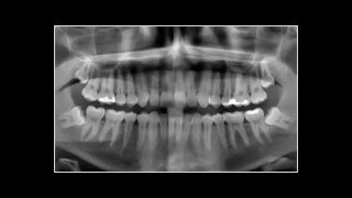 Удаления зуба мудрости(Наша клиника – это огромный медицинский центр, оборудованный по последнему слову техники. Важное преимуще..., 2016-02-02T16:23:07.000Z)