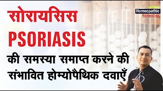 सोरायसिस || Psoriasis || Natural Homeopathic remedies with Symptoms || होम्योपैथिक उपचार