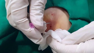 표피낭  조기치료 epidermal cyst