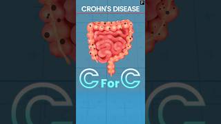 Revise Crohns Disease Explained Via Mnemonic