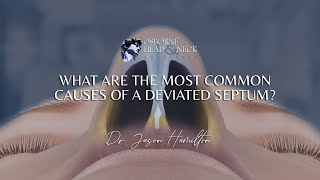 What are the most common causes of a deviated septum?