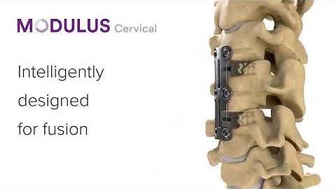NuVasive: Modulus Cervical