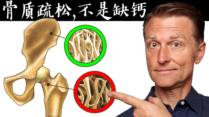 骨质疏松,不是缺钙, 缺钙症状与原因,自然疗法,柏格医生 Dr Berg - 天天要闻
