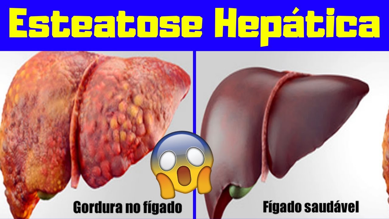O que é Esteatose Hepática? Causas e Tipo? - Gordura no Figado - YouTube