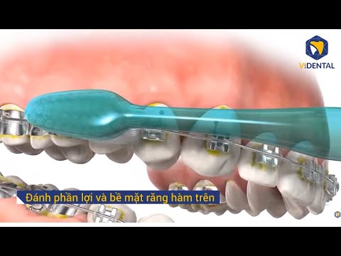 Video: 3 Cách Chăm Sóc Niềng Răng Của Bạn