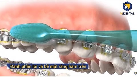 Cách Chăm Sóc và Vệ Sinh Răng Miệng Khi Niềng Răng Mắc Cài