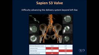 How I Managed a Difficult Sapien TAVR Case - M. Chadi Alraies, MD