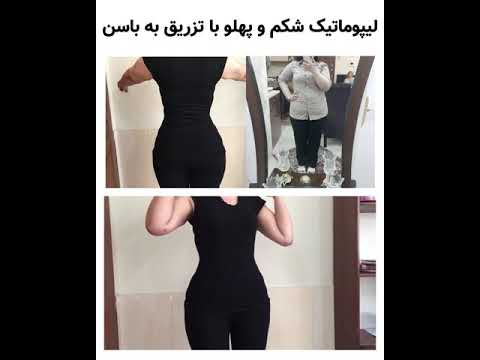 تصویری: Tummy Tuck: آنچه شما باید قبل از انجام عمل جراحی ابدومین بدانید