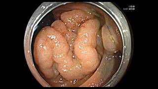 HOW TO PERFORM AN EMR LIKE MICHAEL BOURKE - FLORIDA LIVE EDUCATIONAL VIDEO