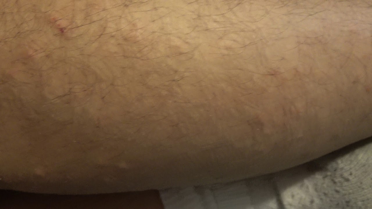 Red Itchy Bumps On My Arms Legs Day 1266 6 17 18 Youtube