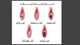 ليلة الدخله فى الاسلام انواع غشاء البكارة الغشاء الغير مثقوب