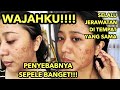Cara Ampuh Usir Jerawat Bandel yang Selalu Tumbuh di Tempat yang Sama