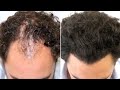 FUE Hair Transplant (2744 Grafts NW IV-V A) by Dr Juan Couto - FUEXPERT CLINIC, Madrid, Spain
