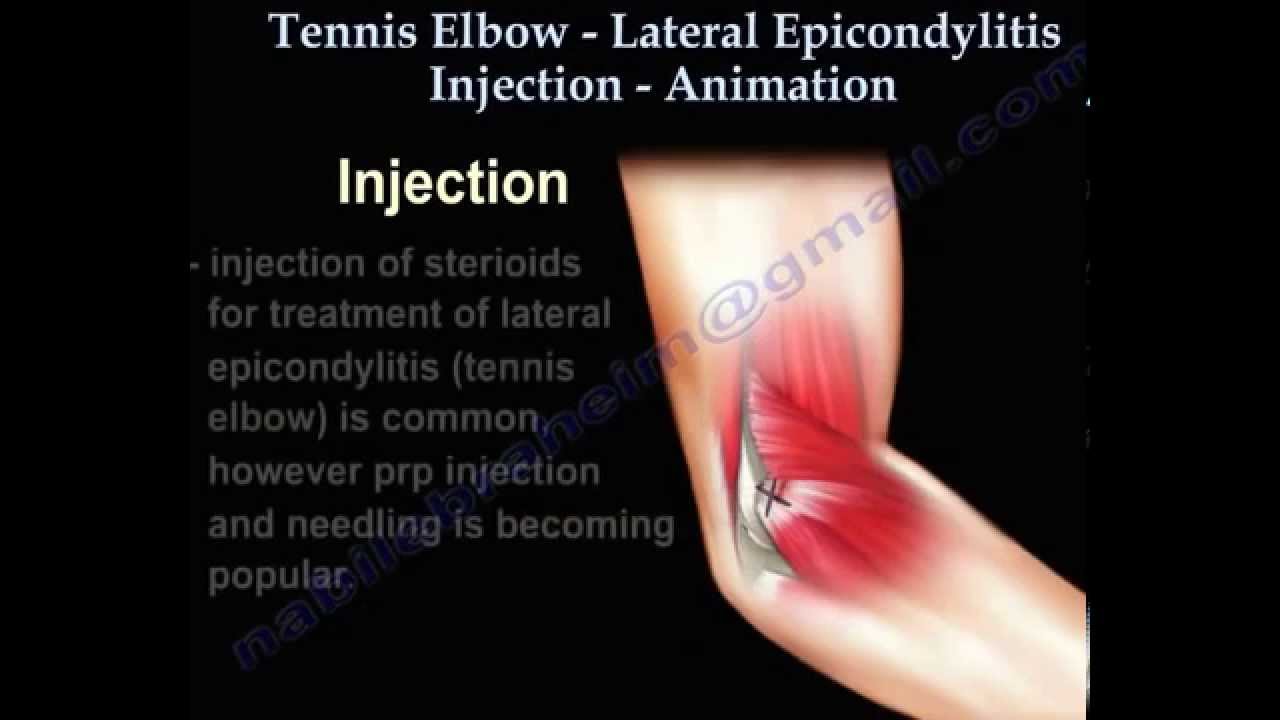 ORTHOMED Elbow US Guided Injection YouTube ORTHOMED Elbow US Guided Injection YouTube