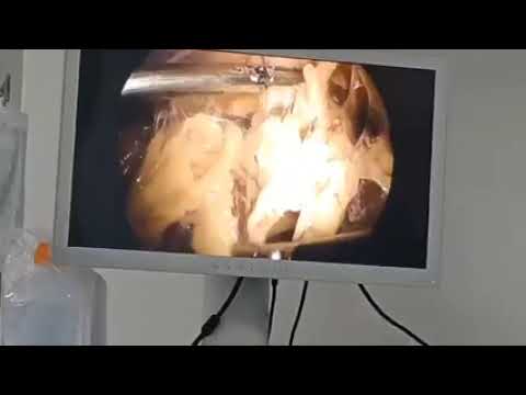 Clinical video 01 thumbnail