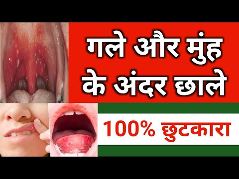 गले में छाले का 100% इलाज | मुंह के छाले का इलाज | Ulcer in throat treatment | Ulcer in mouth,Throat