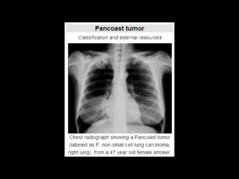 pancoast tumor of the lung and what all it can compress pancoast tumor