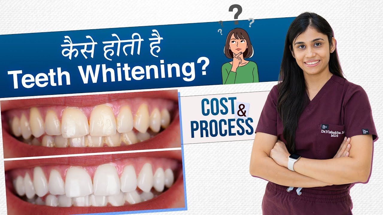 Before You Pay for Teeth Whitening… Watch This! Full Process + Cost | Best Dentist in Indore